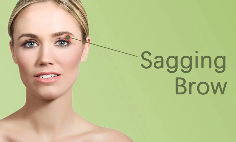 Sagging Brow Treatment in Surat in Surat