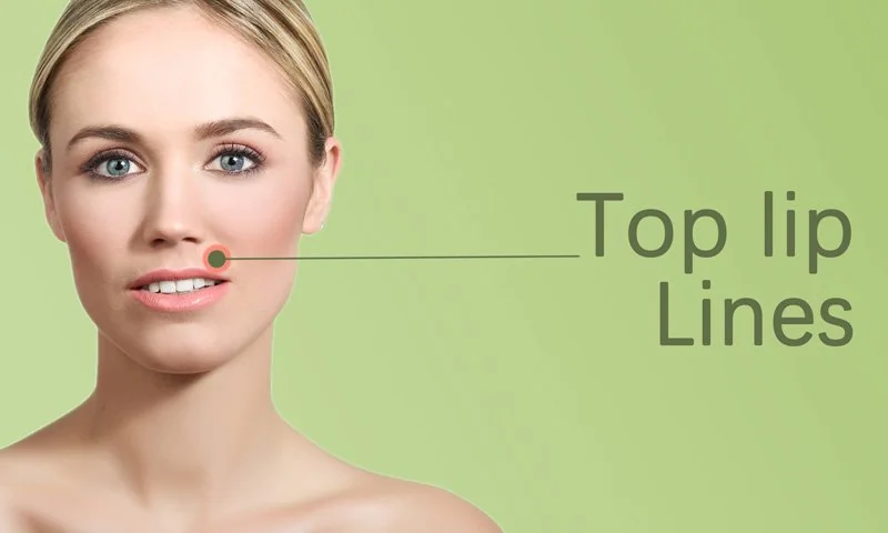 Top Lip Lines in Surat in Surat