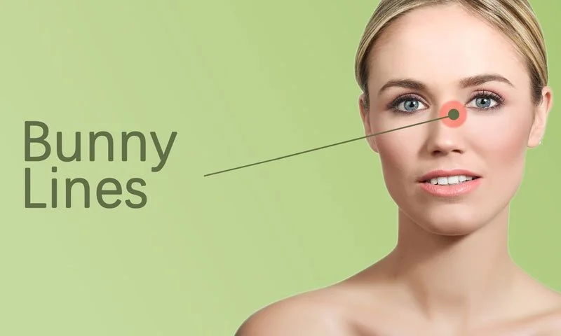 Bunny Lines and Nose Treatment in Surat in Surat