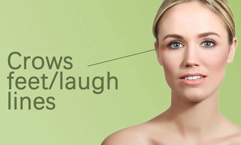 Crow’s Feet and Laugh Lines in Surat in Surat
