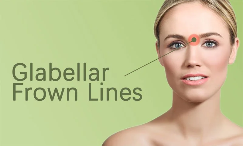 Forehead and Frown Lines Treatment in Surat in Surat