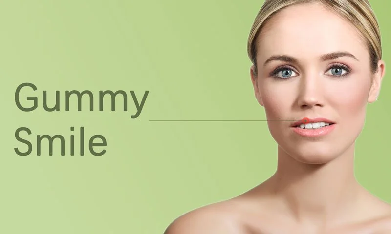 Gummy Smile Treatment in Surat in Surat