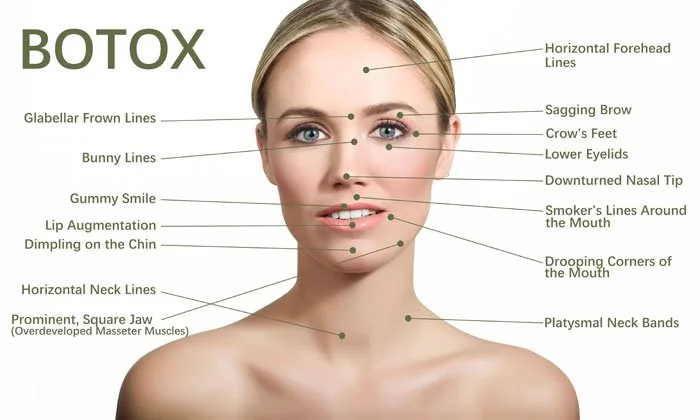 Facial areas treated with Botox at Elegance Clinic Surat
