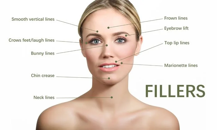Facial areas treated with dermal fillers at Elegance Clinic Surat